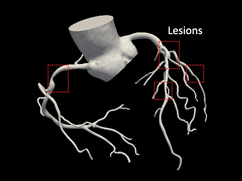 Anatomic segmentation - step two in four-step process illustrating how Owais Khan develops a 3D computer model of patients’ hearts