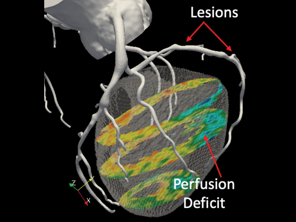 Ventricle segmentation - step three in four-step process illustrating how Owais Khan develops a 3D computer model of patients’ hearts