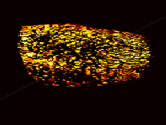 Photoacoustic map of kidney with scarring